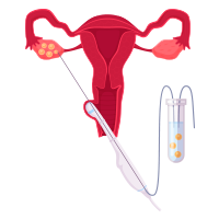 Transvaginal Oocyte Retrieval